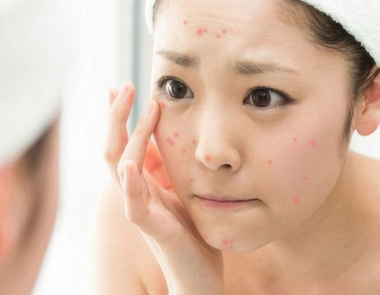 Tại sao không nên tự nặn mụn?